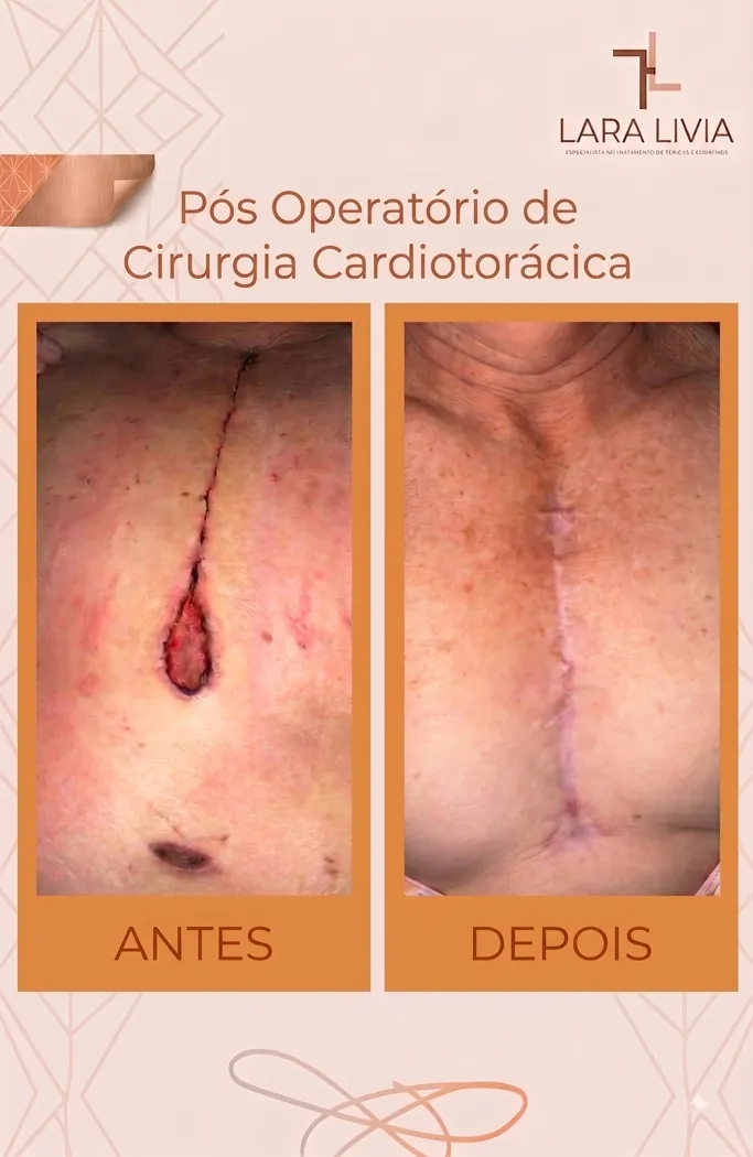 Antes e depois — pós-operatório de cirurgia cardiotorácica, caso tratado pela Enf. Lara Lívia em Mossoró – RN