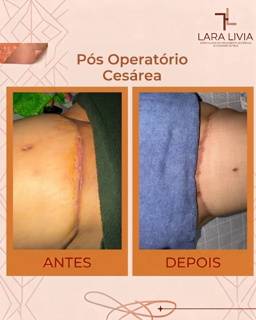 Antes e depois — pós-operatório de cesárea, caso tratado pela Enf. Lara Lívia em Mossoró – RN