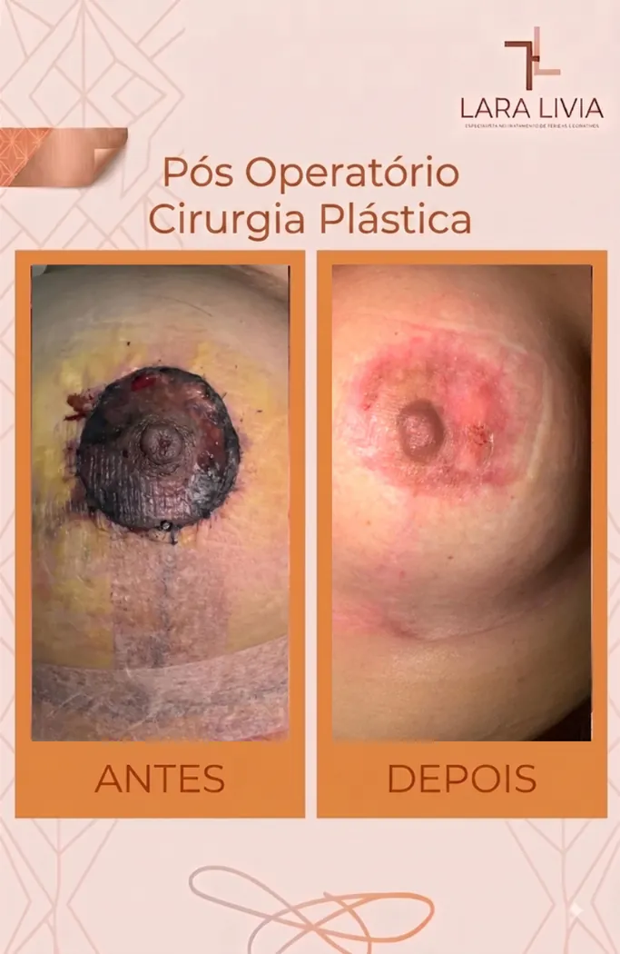 Antes e depois — pós-operatório de cirurgia plástica, caso tratado pela Enf. Lara Lívia em Mossoró – RN