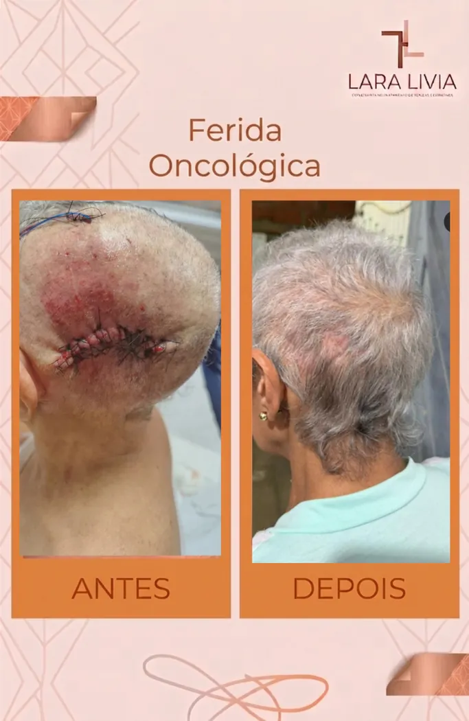 Antes e depois — ferida oncológica, caso tratado pela Enf. Lara Lívia em Mossoró – RN