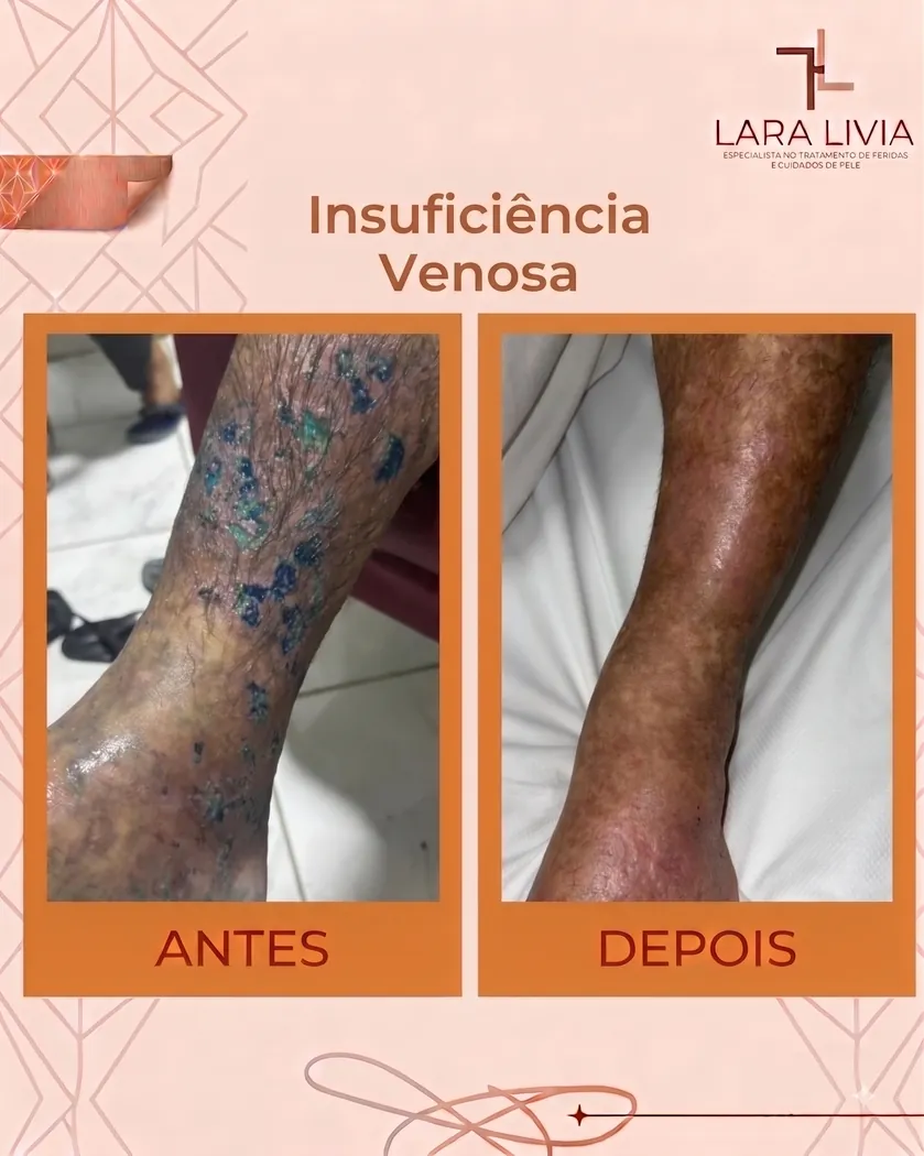 Antes e depois — insuficiência venosa, caso tratado pela Enf. Lara Lívia em Mossoró – RN