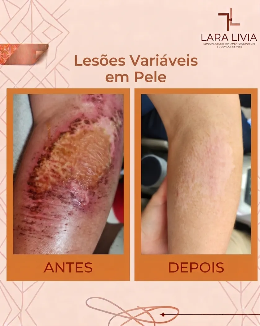 Antes e depois — lesões variáveis em pele, caso tratado pela Enf. Lara Lívia em Mossoró – RN